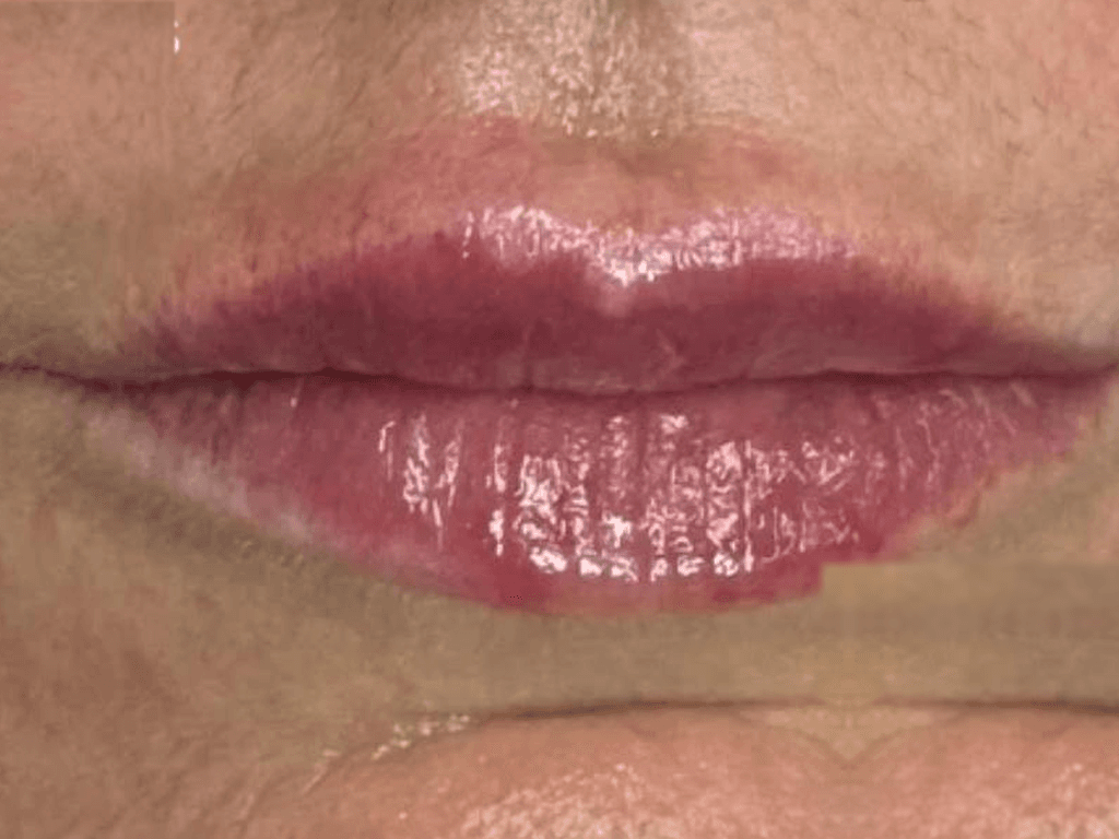 Aumento de labios — Después
